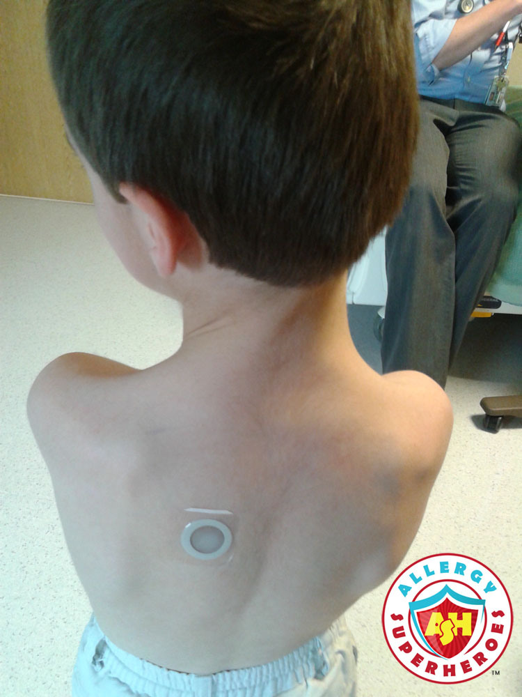 Boy wearing the Viaskin Peanut Patch | Food Allergy Treatment news | Allergy Superheroes
