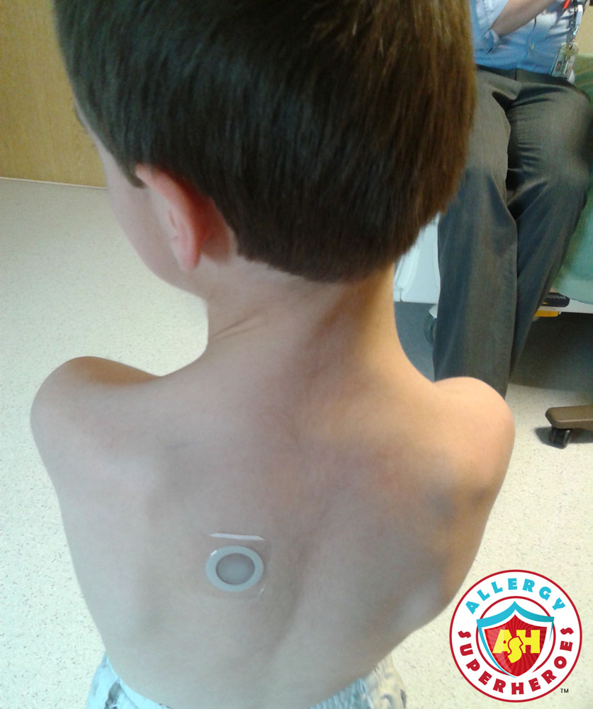 Kal's first peanut patch | Food Allergy Superheroes